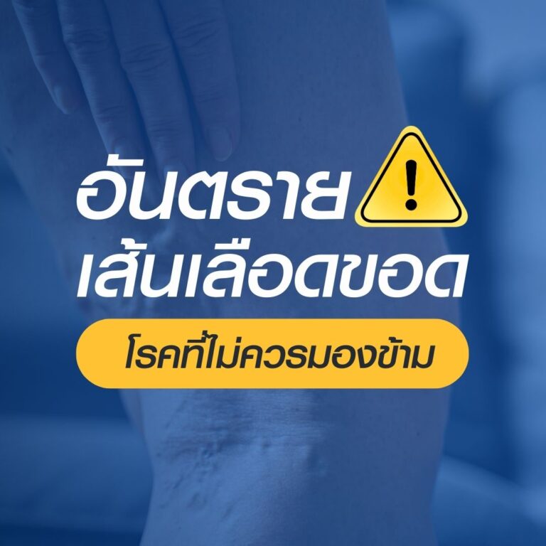 เลเซอร์รักษาเส้นเลือดขอด รพ.ธนบุรี ทุ่งสง