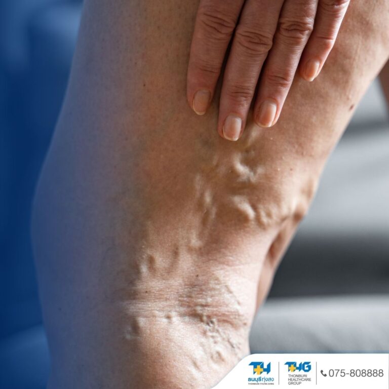 เส้นเลือดขอดที่ขาใกล้มือ – รพ.ธนบุรี ทุ่งสง