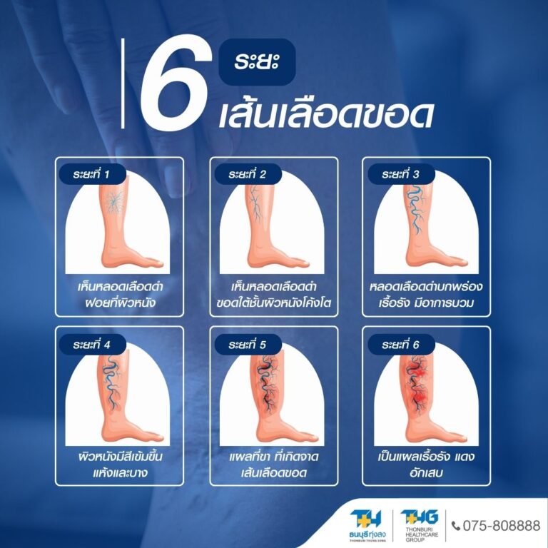 6 ระยะเส้นเลือดขอด อินโฟกราฟิก