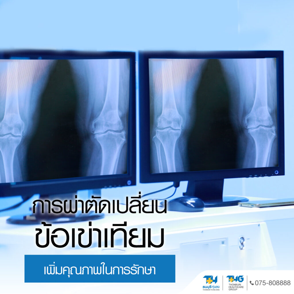 ภาพ X-ray ข้อเข่าเพื่อวางแผนผ่าตัด โรงพยาบาลธนบุรี ทุ่งสง
