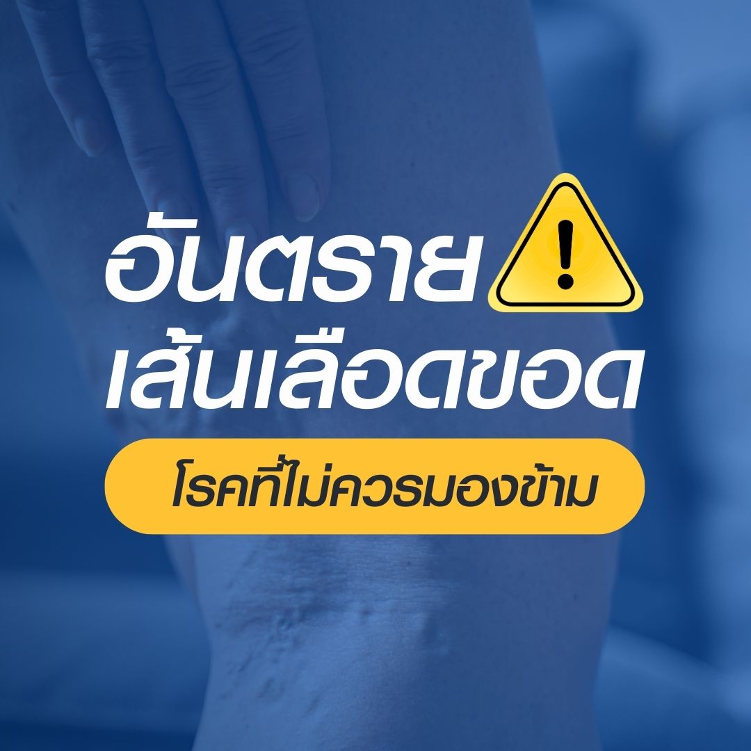 เทคโนโลยี EVLT ปิดหลอดเลือดขอด แผลเล็ก พักฟื้นไว ที่รพ.ธนบุรี ทุ่งสง